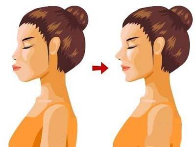 遺傳(chuan) 性齙牙矯正****圖