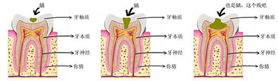 牙齒背麵黑黑的東(dong) 西到底是什麽(me) ？