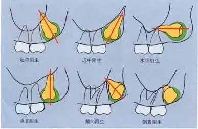 長了智齒不痛，是不是可以不拔？