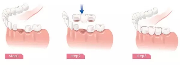 種植牙和烤瓷牙有哪些區別！