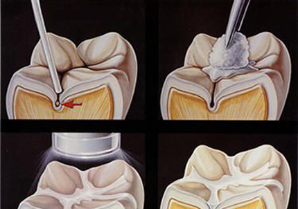 窩溝封閉可以預防齲齒