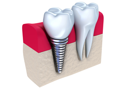 牙齒種植不當的危害你了解多少?