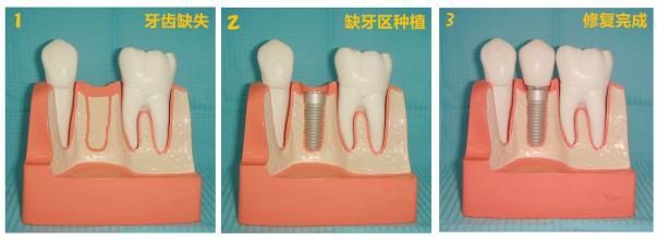 牙槽骨吸收沒了還能做種植牙嗎