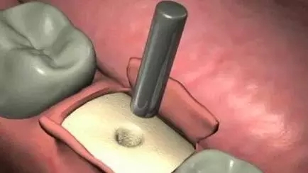 種植牙的過程是怎樣的？