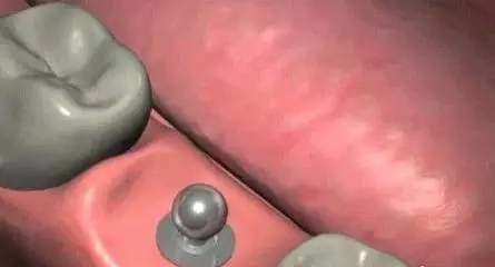 種植牙的過程是怎樣的？