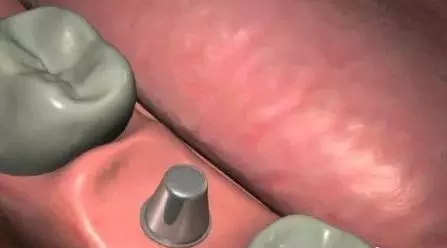 種植牙的過程是怎樣的？