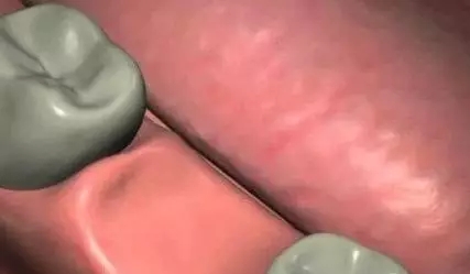 種植牙的過程是怎樣的？