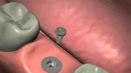 種植牙的過程是怎樣的？