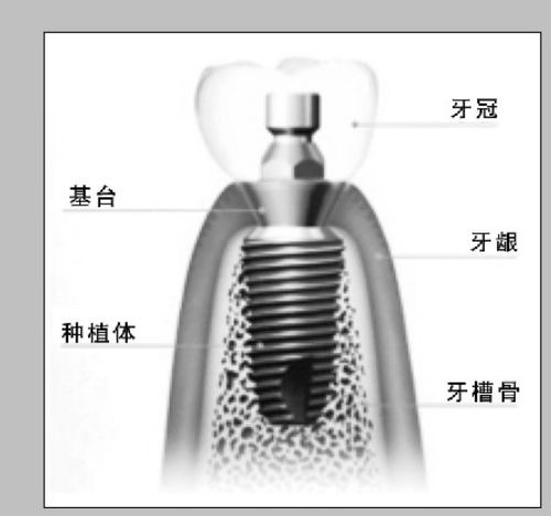 種植牙價(jia) 格變化的因素