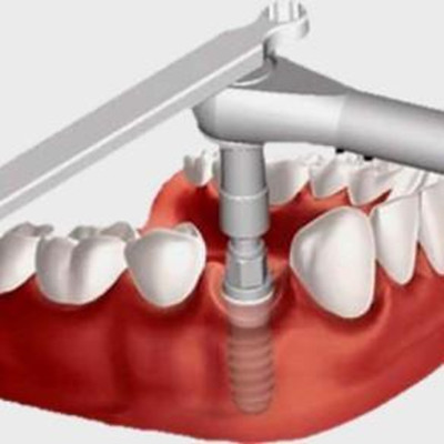 怎麽(me) 確定自己適合種植牙