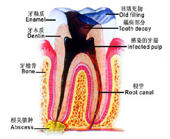 預防牙髓炎