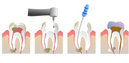 根管治療是怎麽(me) 治療牙髓炎的