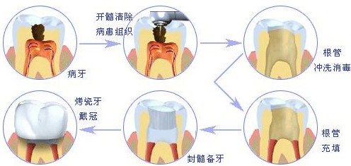 牙髓炎如何治療