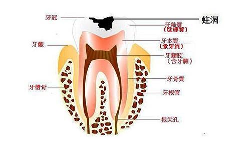 急性牙髓炎治療