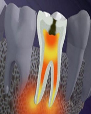 急性牙髓炎