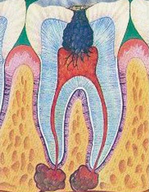 牙髓炎會(hui) 不會(hui) 傳(chuan) 染呢