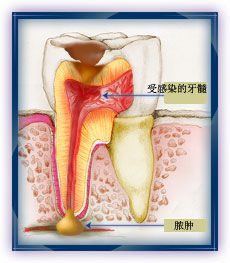 牙髓炎的治療