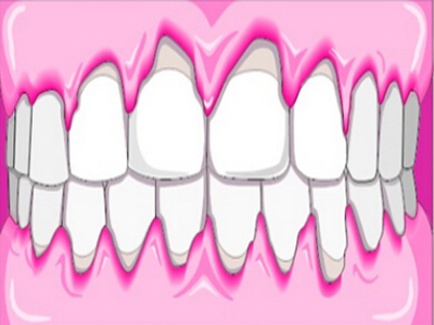 牙齦出血提前預防！