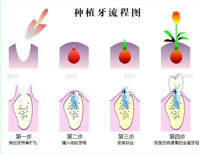 種植牙流程