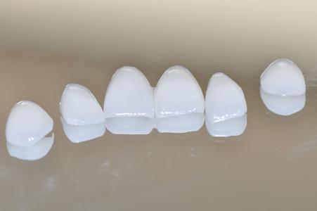 牙齒美白貼麵價(jia) 格