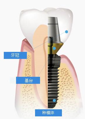 深圳做種植牙有危害嗎