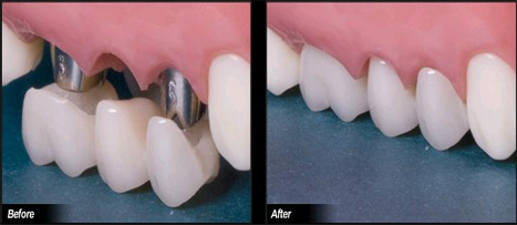 全口種植牙的價(jia) 格