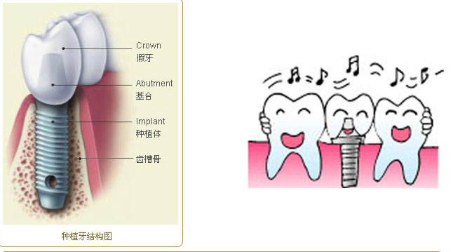 種植牙人適宜嗎？