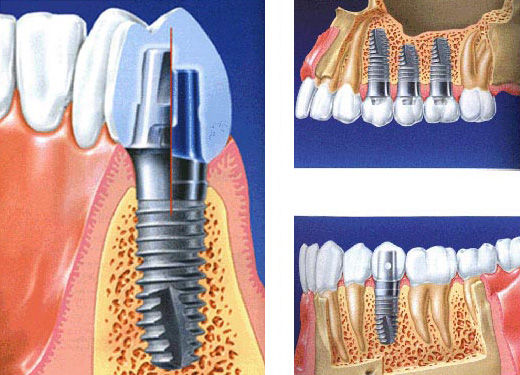 深圳全口種植多少錢
