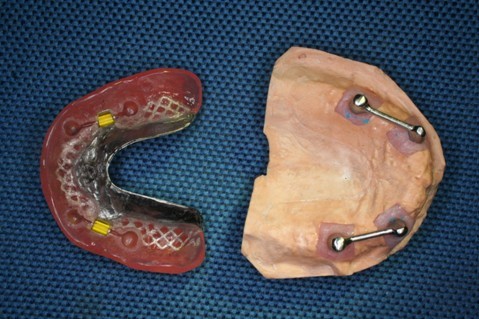 深圳種植義(yi) 齒好嗎?