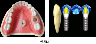 種植牙怎麽(me) 護理