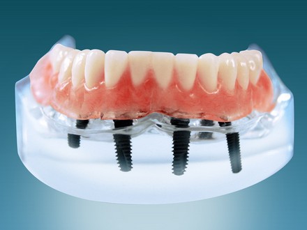 深圳種植牙價(jia) 格一覽表