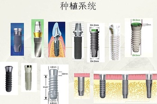 深圳種植牙價(jia) 格一覽表