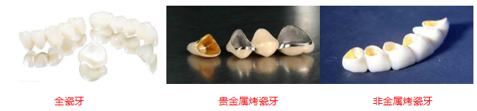 烤瓷牙種類