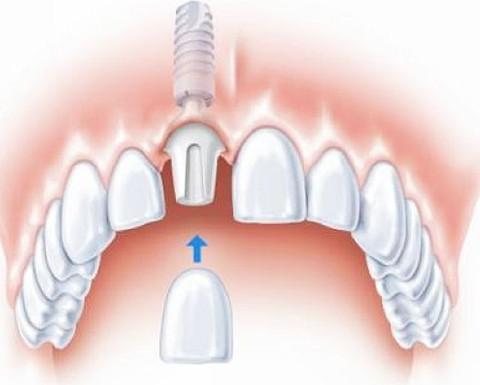 鑲牙的方法都有哪些