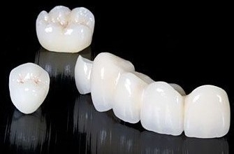 全瓷牙和烤瓷牙的區別