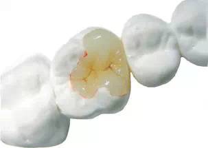 深圳嵌體(ti) 補牙到底要多少錢