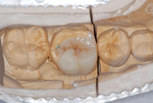 嵌體(ti) 和填充體(ti) 的區別