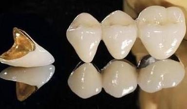 嵌體(ti) 補牙的適應症與(yu) 注意事項
