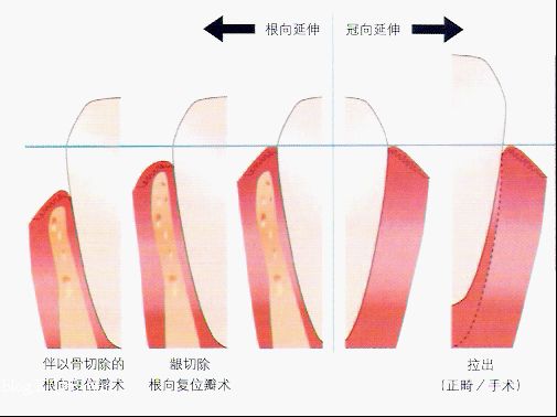 什麽(me) 是冠延長術