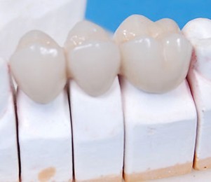 假牙的壽命有多長