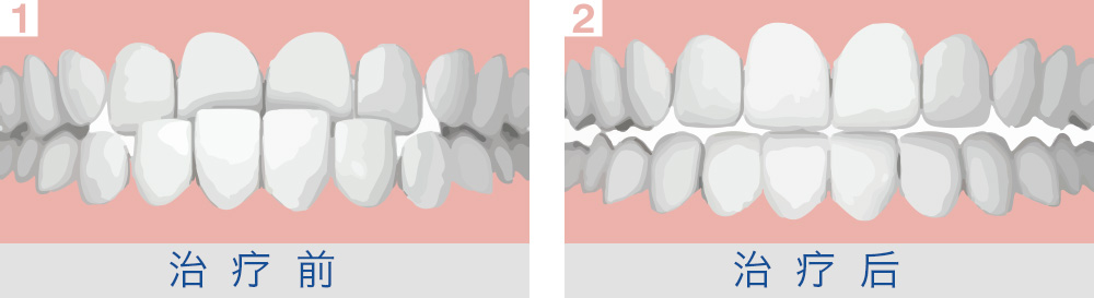 治療地包天的方式有哪些