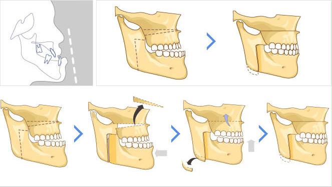 地包天是什麽(me) 原因