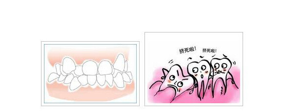 牙齒擁擠的情況應該怎麽(me) 矯正