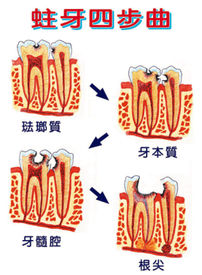 齲病後一定會(hui) 疼痛嗎