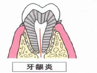 牙齦炎是怎麽(me) 形成的？