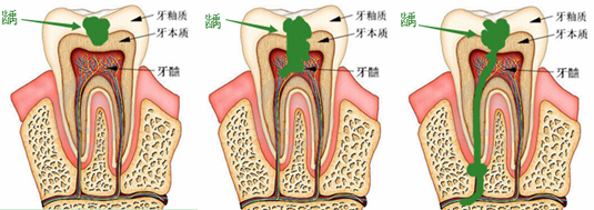 年輕人牙髓炎的病因有哪些呢