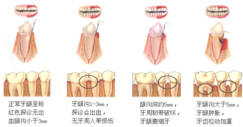 什麽(me) 是牙周炎呢？它會(hui) 帶來哪些危害呢？