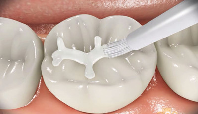 窩溝封閉後注意事項