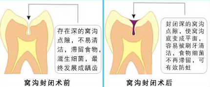 塗氟、窩溝封閉更好的保護孩子的牙齒