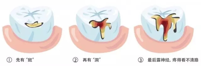 寶寶蛀牙不管會(hui) 帶來哪些危害